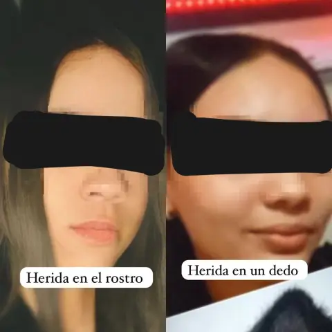 Menor resulta herida en el rostro tras enfrentamiento con otra adolescente en Mao